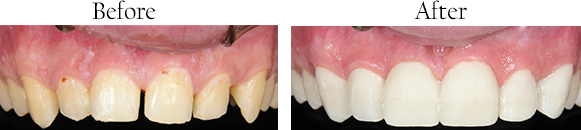dental implants in san angelo